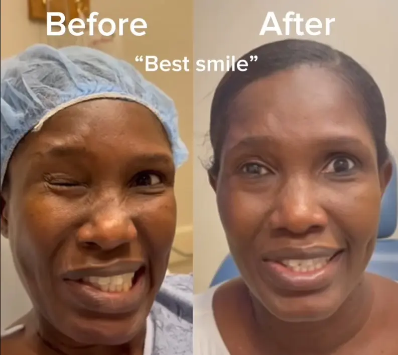 Facial nerve stroke before/after